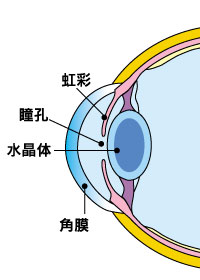 未熟白内障
