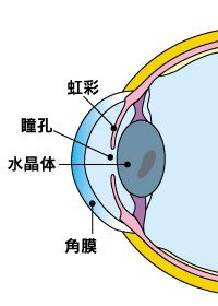 過熟白内障